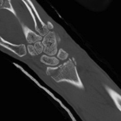 Dislocated Radiocarpal Joint CT 3